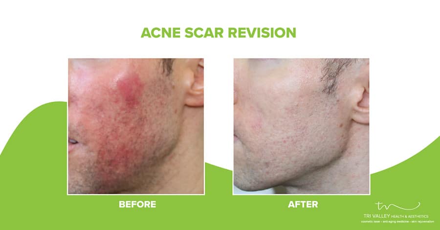 patient testimonial co2 laser treatments for acne scars 5fce7e3aa6c7c